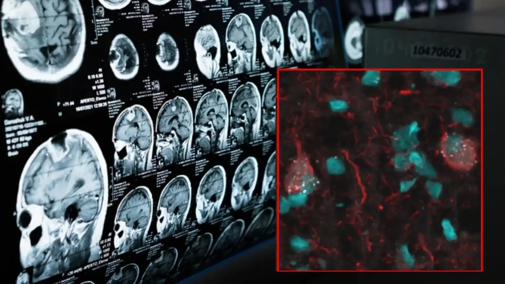 Hito contra el alzhéimer: un tratamiento elimina las ‘células zombi’ que inflaman el cerebro